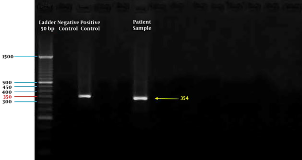 The NP-1 gene of human bocavirus (HBoV). Left to right: ladder, negative control, NP-1 plasmid cloned as a positive control, the patient’s sample.