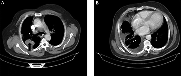 A, Axial contrast computed tomography (CT) scan of the chest shows a 36 × 52 mm lung mass within right upper lobe (RUL) (arrow); B, right-sided pleural thickening and effusion.