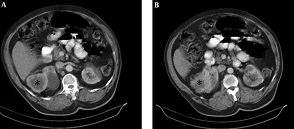 A and B, Heterogeneous enhancing mass with central necrosis has been detected at the upper pole of the right kidney.