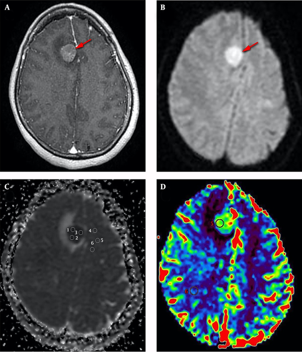 A 62-year-old female with right frontal secondary CNS lymphoma. An axial, contrast-enhanced, and T1-weighted; image (a) shows a homogenous enhancement (arrow). An axial diffusion-weighted image, with b-values of 1,000 s/mm2 (b), shows a homogenous hyperintensity. ADC map (c) shows 3 ROIs were placed within the lowest signal area of the mass, and 3 additional ROIs were placed within the opposite normal white matter. CBV map (d) shows an ROI was placed within the most vascular proliferative area of the mass, corresponding to the highest color spectrum, and another ROI was placed within the normal white matter.