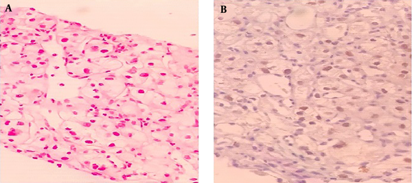 Right kidney mass biopsy, A, Hematoxylin and eosin stain (H &amp; E) image of neoplasm composed of cells with clear cytoplasm, distinct cell borders, and moderately pleomorphic nuclei; B, the neoplastic cells showed a positive nuclear reaction for paired box gene 8 (PAX8).
