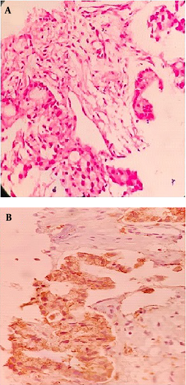 Right upper lobe (RUL) biopsy, A, Hematoxylin and eosin stain (H &amp; E) image of lung parenchyma infiltrated by a neoplasm, composed of cuboidal to columnar cells with light eosinophilia and moderately pleomorphic nuclei arranged in different sized glandular structures; B, neoplastic cells are diffusely and strongly positive for Napsin A.