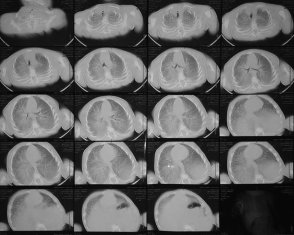 lung CT scan of patient No. 8 with a bilateral ground-glass appearance