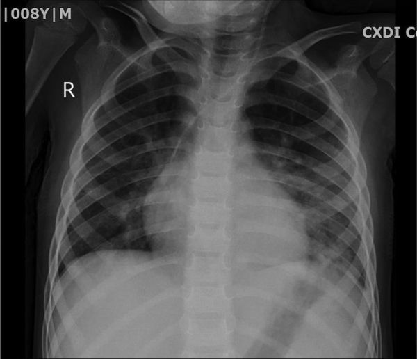 The near normal chest X-ray of patient after the therapy