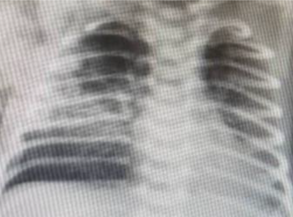 Chest X-ray of patient No. 5 with consolidation and involvement of both lungs