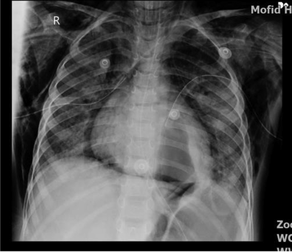 Mediastinal emphysema and left side pneumothorax and pneumatocele