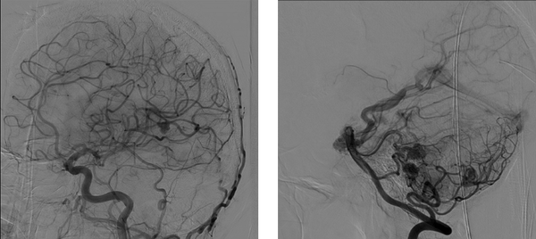 Multiple brain arteriovenous malformations that closed with Onyx glue