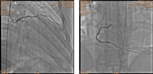 Coronary angiography of the A, left; and B, right coronary arteries.