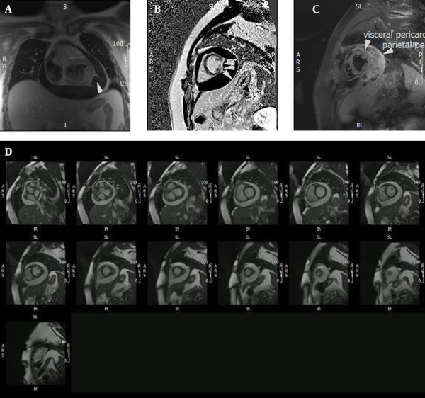 CMR images of ruptured hydatic cyst. A, T1 weighted CMR image depicts ruptured hydatid cyst. B, Late gadolinium enhancement (LGE) image demonstrates cystic ring enhancement in favor of hydatid cyst. C, In rhe STIR CMR image in short acis view diffuse parietal and visceral pericardial edema is noticeable. D, Stack short axis CMR view of left ventricle indicates to large circumferential pericardial effusion.