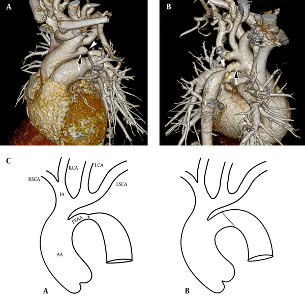 A and B, oblique-coronal volume-rendered reconstruction CT angiography images of the great arteries from A, anterior; and B, posterior views. Note the persistent fifth aortic arch (arrows) with associated coarctation (arrowheads); C, schematic illustrations of A, preoperative; and B, postoperative; configuration of the aortic arch (AA, ascending aorta; IA, innominate artery; R, right; L, left; SCA, subclavian artery; CA, carotid artery; PFAA, persistent fifth aortic arch).