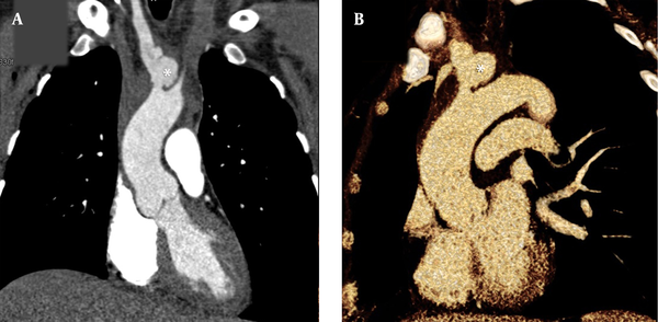 Thoracic CT angiography. A, Multiplanar reconstruction image; and B, volume-rendering technique; of great arteries in the coronal plane demonstrate a contrast-filled outpouching protruding from the proximal part of the innominate artery with irregular borders in favor of pseudoaneurysm (asterisks).