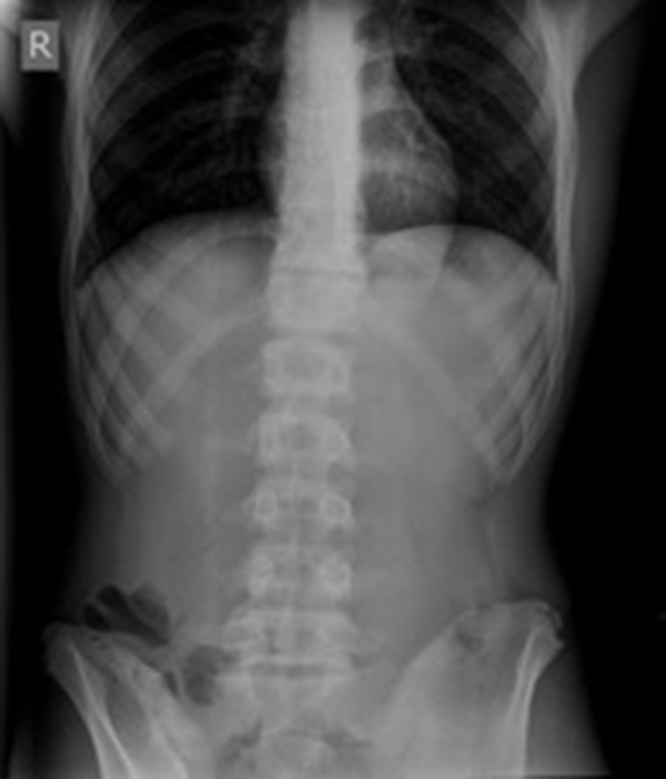 Preoperative plain abdominal radiography of a patient with duodenal ulcer perforation. Although intraabdominal free air is not seen, the air-fluid level in the right lower quadrant of the abdomen is remarkable.